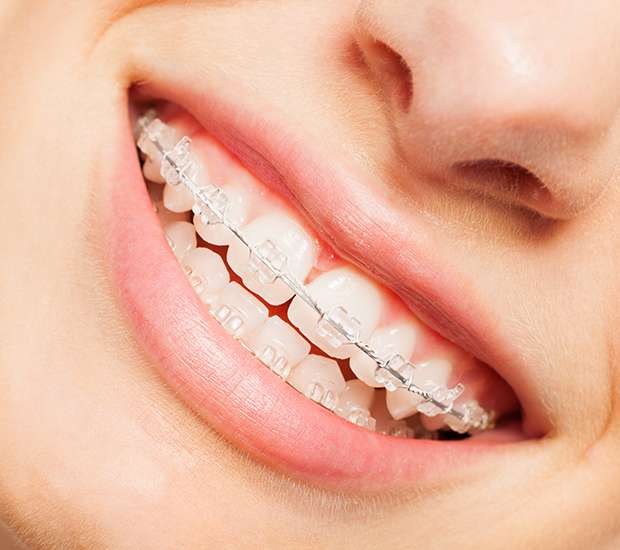 Clearwater Clear Braces
