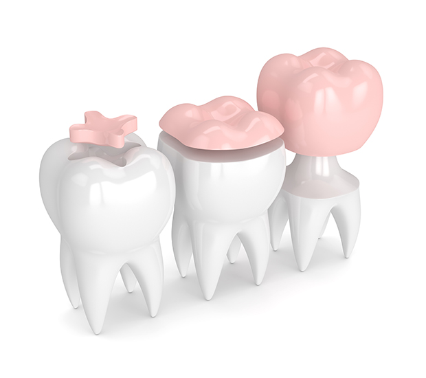 Clearwater Dental Inlays and Onlays